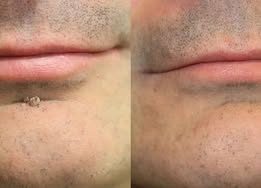 🥑Purelora®2-in-1 Microneedle & Hydrocolloid Patch| Removes Raised Moles, Acne, Flat Warts & Skin Tags | Helps Improve Wrinkles, Scars & Blemishes | Invisible Patches for Face & Body（副本）