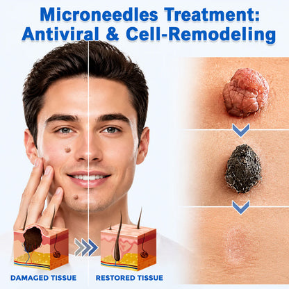 🥑Purelora®2-in-1 Microneedle & Hydrocolloid Patch| Removes Raised Moles, Acne, Flat Warts & Skin Tags | Helps Improve Wrinkles, Scars & Blemishes | Invisible Patches for Face & Body（副本）