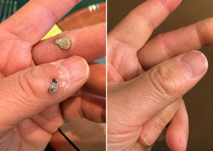 🥑Purelora®2-in-1 Microneedle & Hydrocolloid Patch| Removes Raised Moles, Acne, Flat Warts & Skin Tags | Helps Improve Wrinkles, Scars & Blemishes | Invisible Patches for Face & Body（副本）
